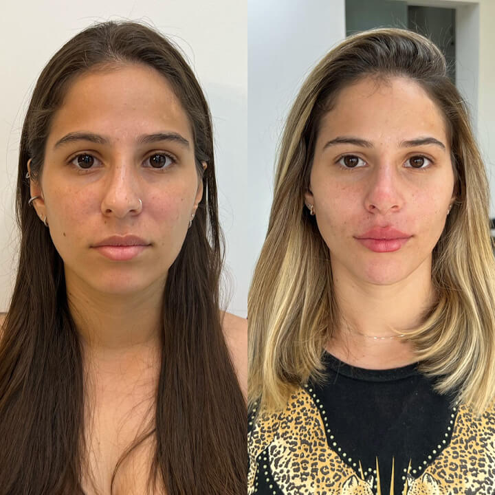 Antes e depois 2