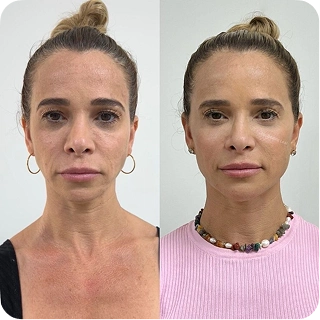 antes-e-depois01.webp