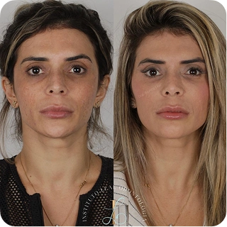 antes-e-depois03.webp