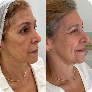 antes-e-depois11.webp
