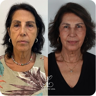 antes-e-depois12.webp
