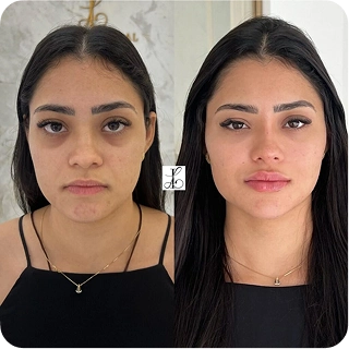 antes-e-depois17.webp