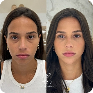 antes-e-depois18.webp