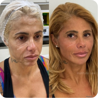 antes_e_depois04.webp