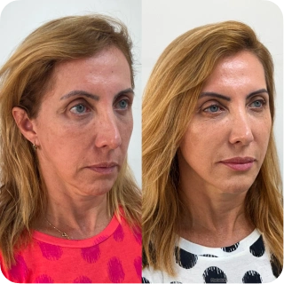 antes_e_depois10.webp